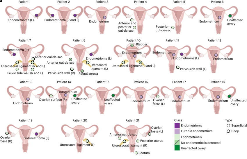 endometrioza